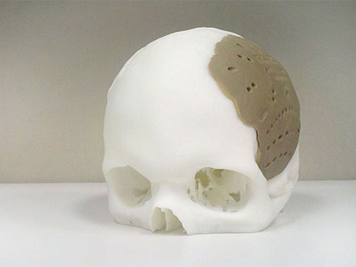 implantes-hueso-impresion-3d-eu